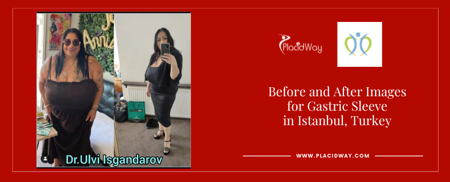 Bariatric Obesity Surgery in Istanbul Turkey
