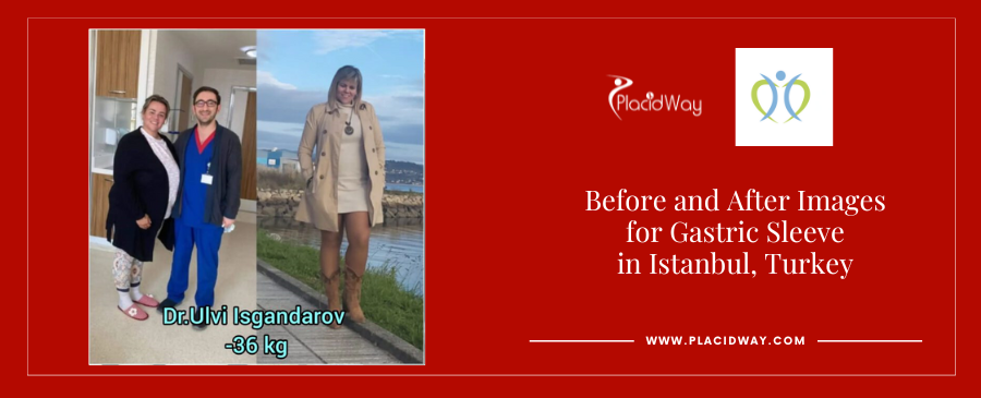 Gastric Sleeve Surgery in Istanbul Turkey