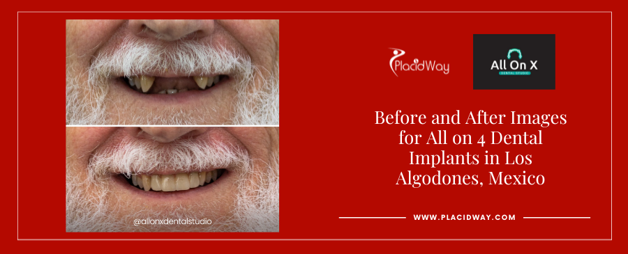 All on 4 Dental Implants in Los Algodones, Mexico Before and After