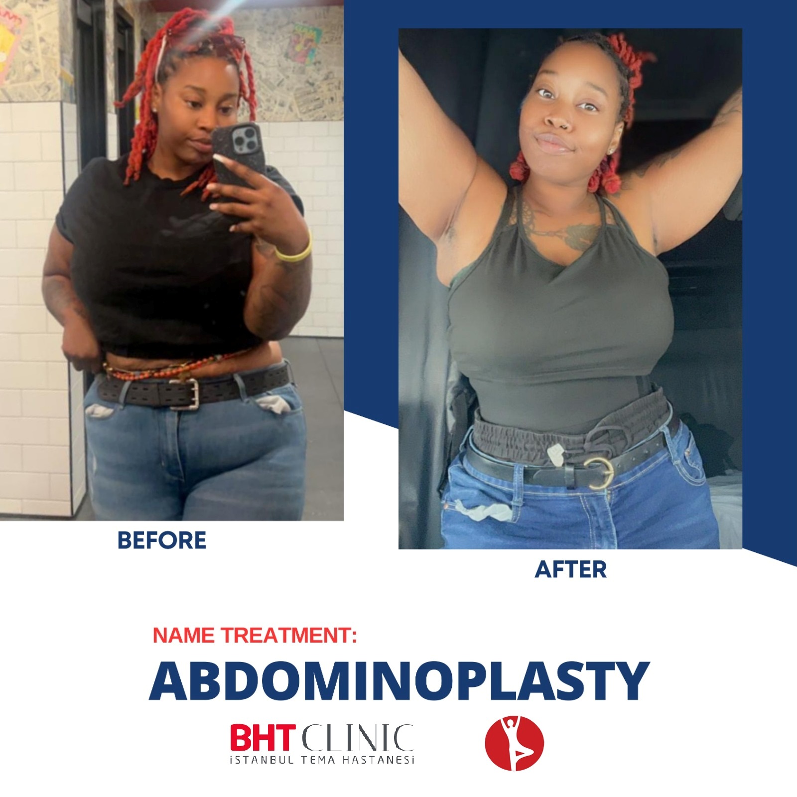 Before and After Abdominoplasty in Istanbul, Turkey