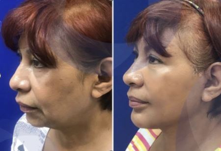 Before and After Facelift Surgery at Gilenis
