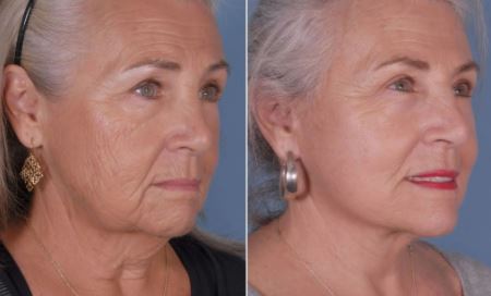 Before and After Facelift n Tijuana, Mexico at Gilenis