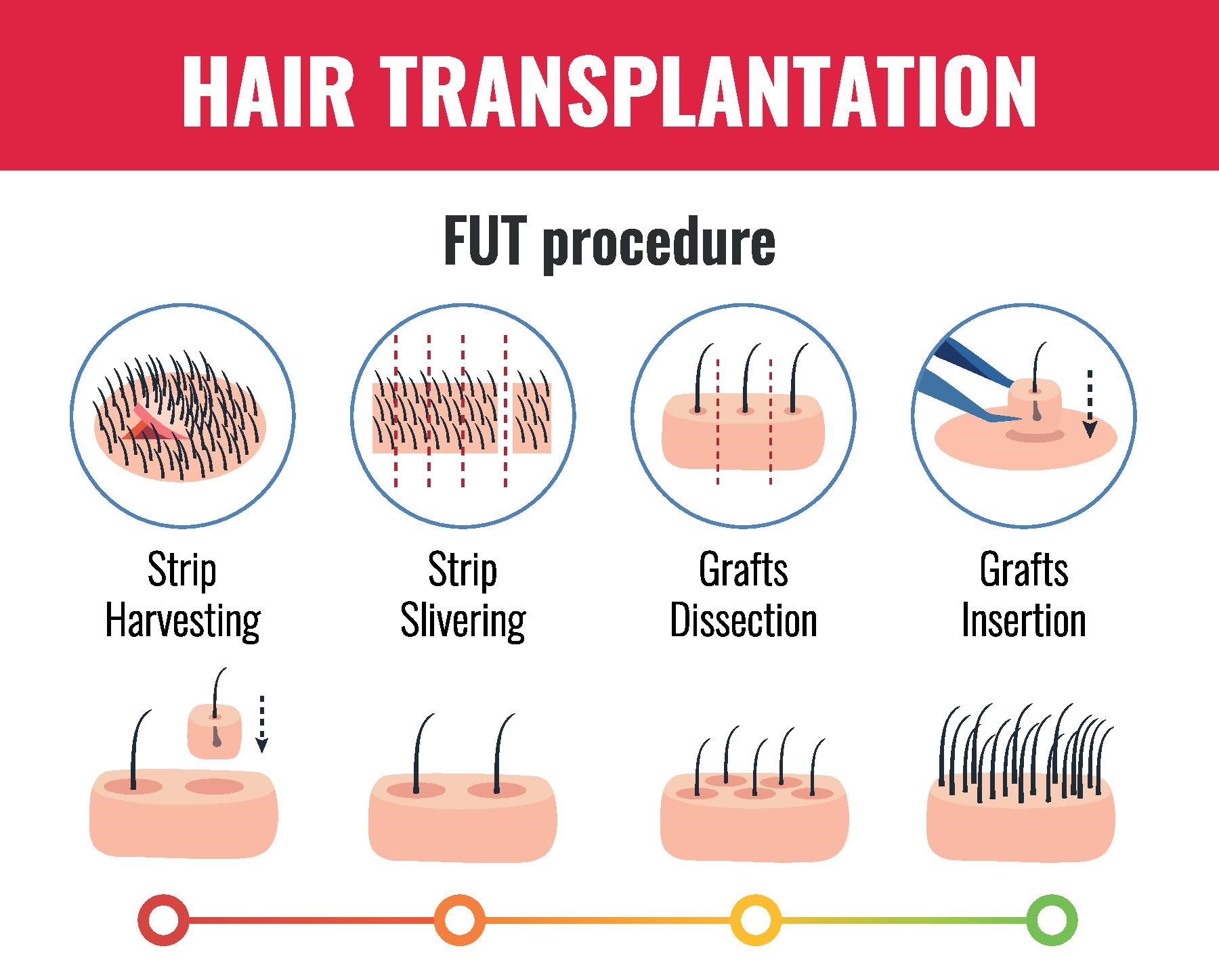 FUT Hair Transplant in turkey
