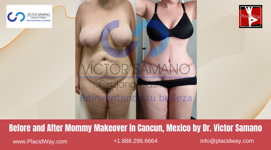 MMO in Cancun, Mexico Dr. Victor Samano Before After Picture