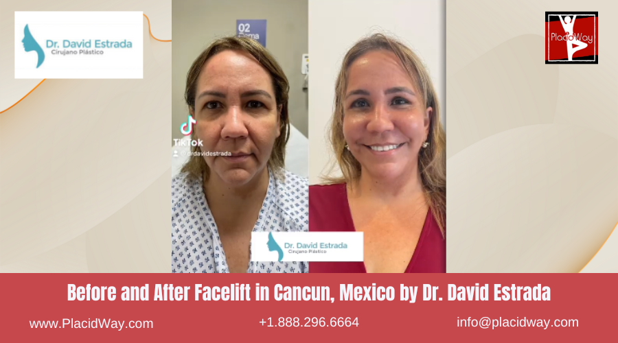 Facelift in Cancun, Mexico Dr. David Estrada Before After Images