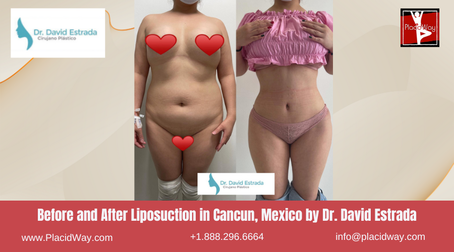 Liposuction in Cancun, Mexico Dr. David Estrada Before and After Images
