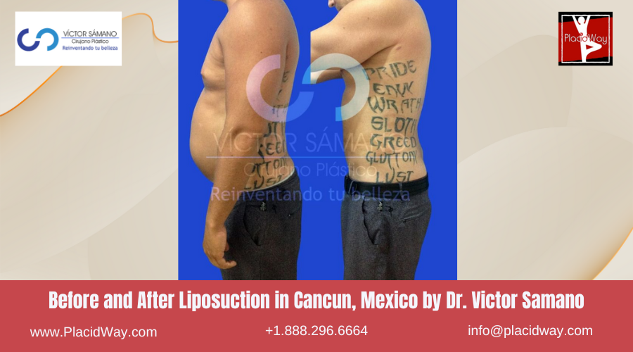 Liposuction in Cancun, Mexico Dr. Victor Samano Before and After Images
