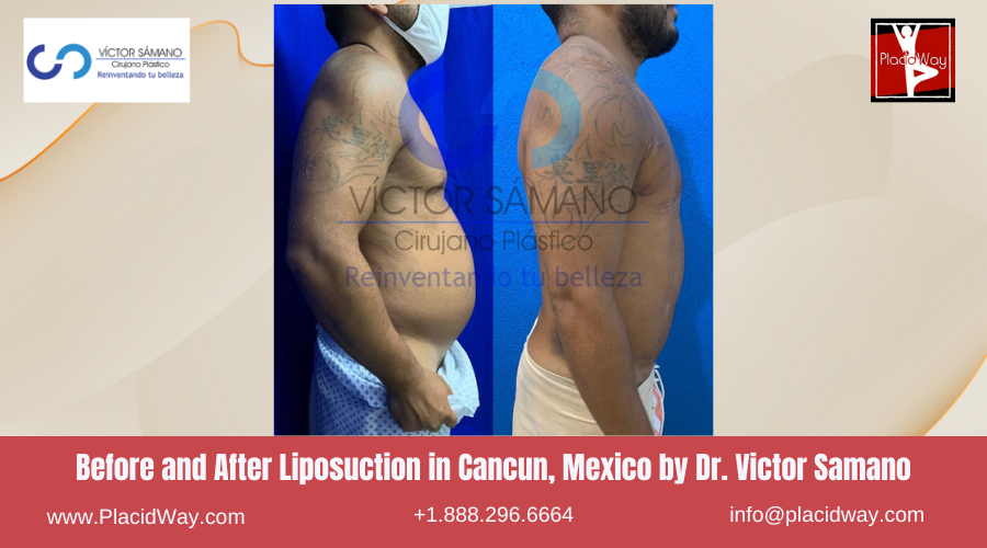 Liposuction in Cancun, Mexico Dr. Victor Samano Before and After Pictures