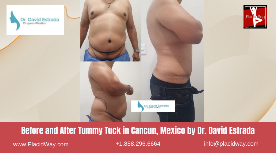 Tummy Tuck in Cancun, Mexico Dr. David Estrada Before After Images