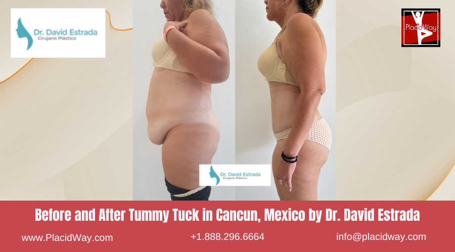 Tummy Tuck in Cancun, Mexico