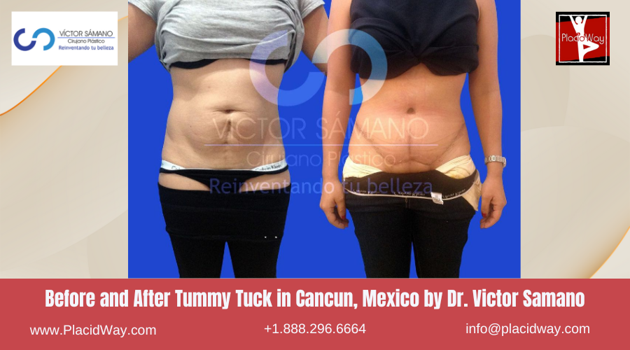 Tummy Tuck in Cancun, Mexico Dr. Victor Samano