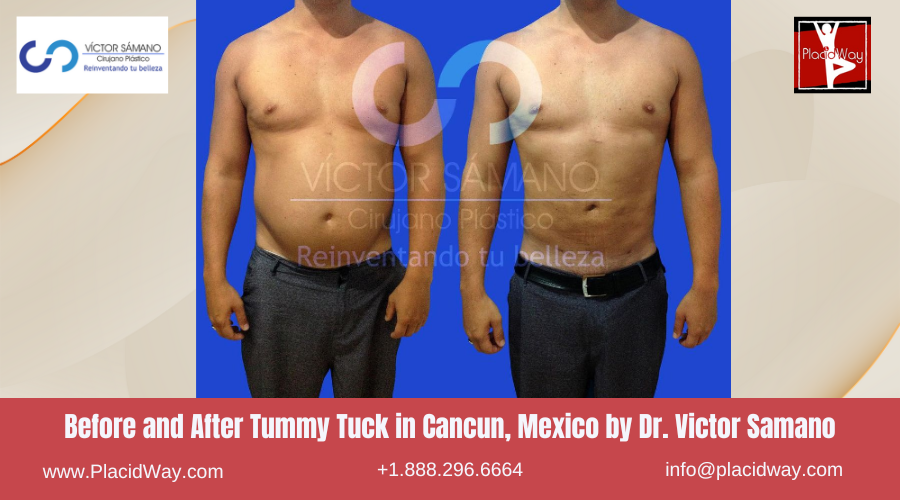 Tummy Tuck in Cancun, Mexico Dr. Victor Samano Before and After