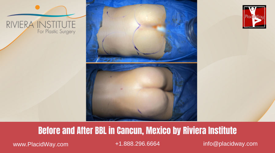 BBL in Cancun, Mexico by Riviera Institute Before After Pictures