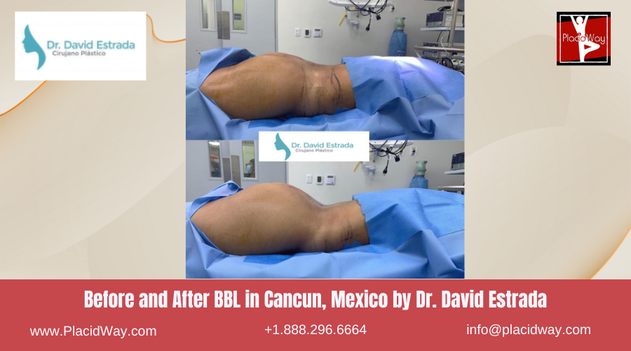 BBL in Cancun, Mexico Dr. David Estrada Before After Pictures