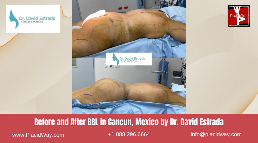 BBL in Cancun, Mexico Dr. David Estrada Before After Images