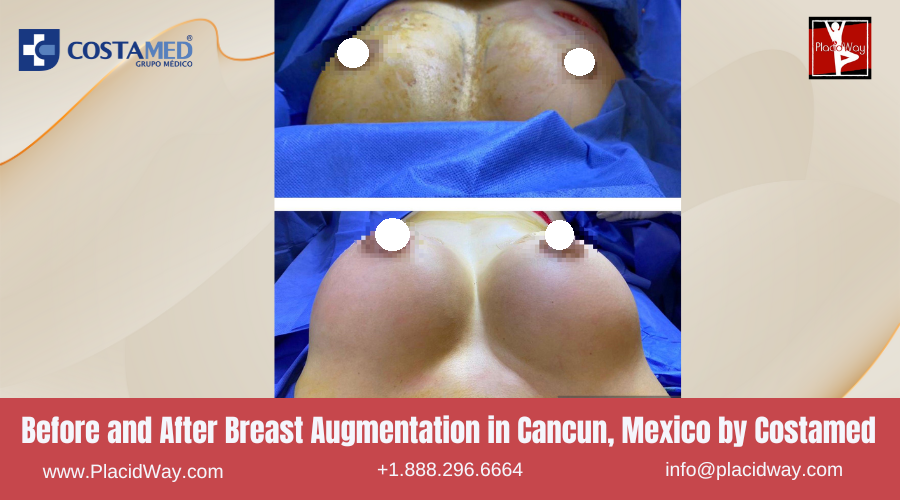 Breast Augmentation in Cancun, Mexico by Costamed Before After