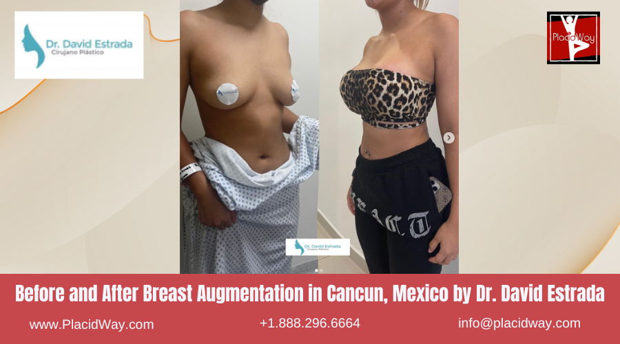 Breast Augmentation in Cancun, Mexico Dr. David Estrada