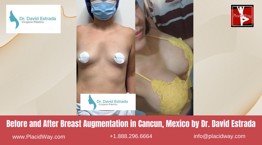 Breast Augmentation in Cancun, Mexico Dr. David Estrada Before After