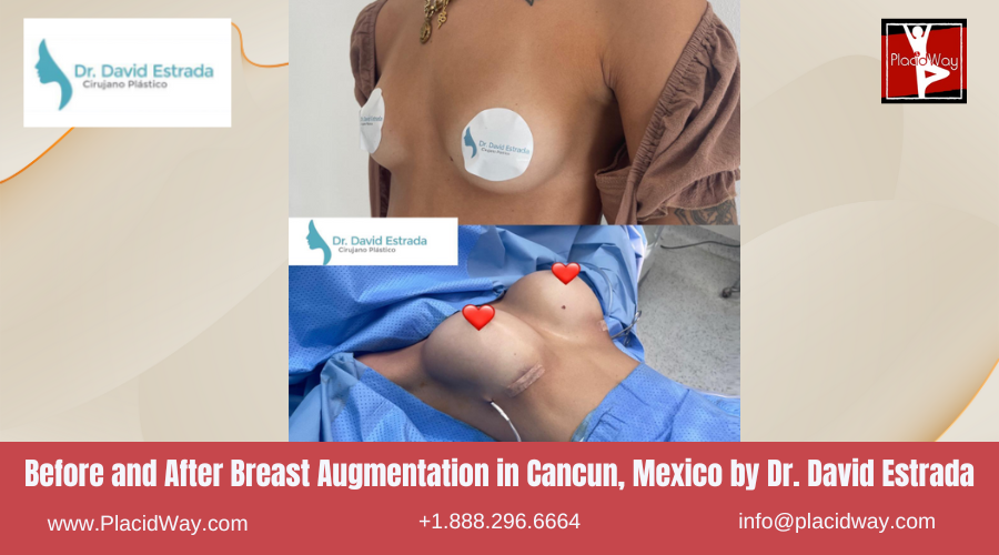 Breast Augmentation in Cancun, Mexico Dr. David Estrada Before and After Image