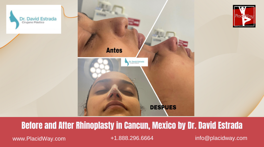 Rhinoplasty in Cancun, Mexico Dr. David Estrada Before After Image