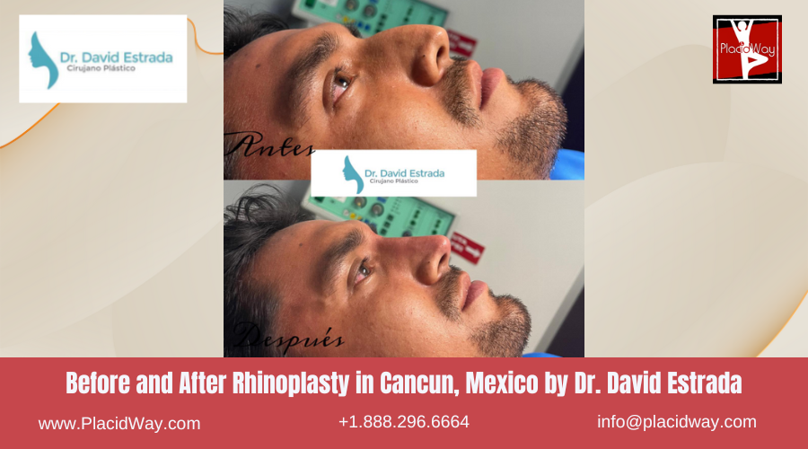 Rhinoplasty in Cancun, Mexico Dr. David Estrada Before After Picture
