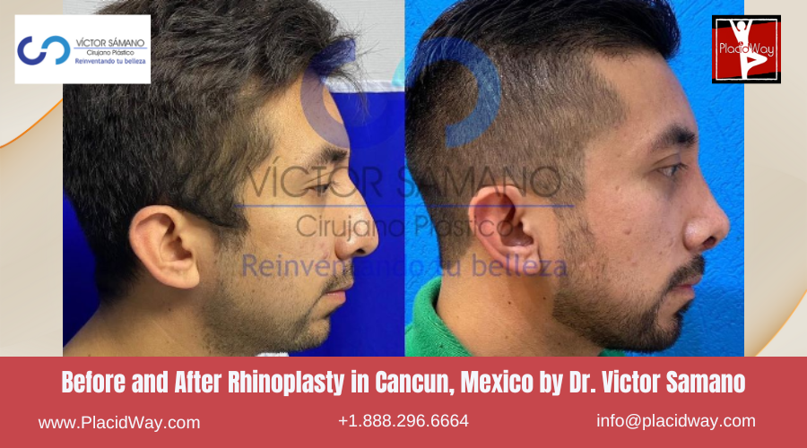Rhinoplasty in Cancun, Mexico Dr. Victor Samano Before After Image