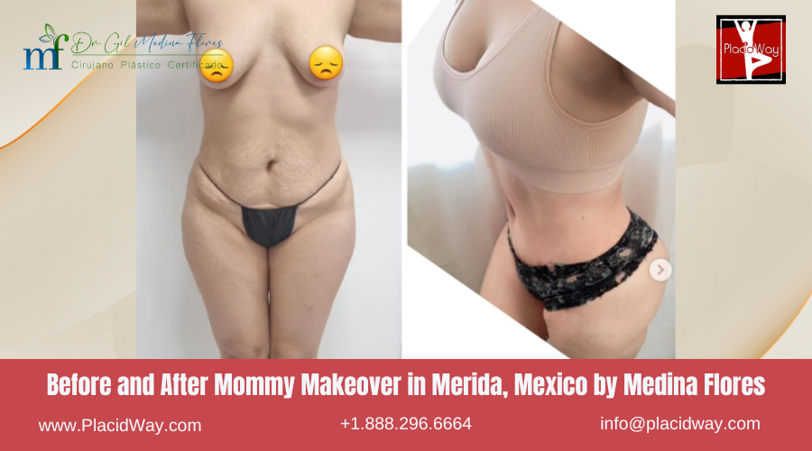 Mommy Makeover in Merida, Mexico by Medina Flores Before After Image