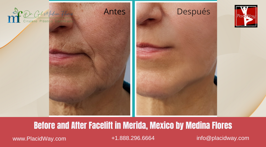 Facelift in Merida, Mexico by Medina Flores Before After Image