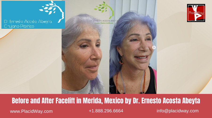 Facelift in Merida, Mexico by Dr Ernesto Acosta Abeyta Before After image