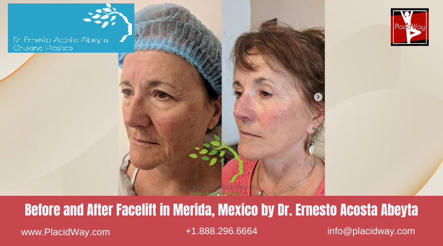Facelift in Merida, Mexico by Dr Ernesto Acosta Abeyta Before After