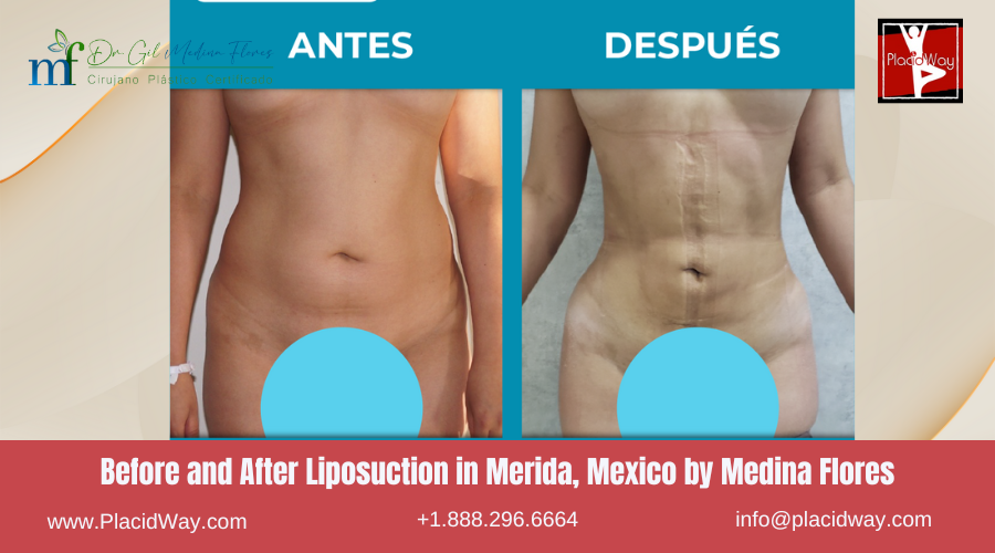 Liposuction in Merida, Mexico by Medina Flores