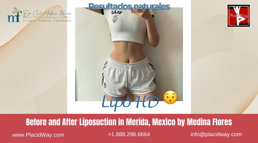 Liposuction in Merida, Mexico by Medina Flores Before After Image
