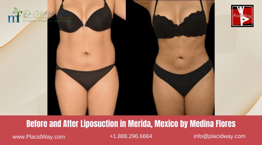 Liposuction in Merida, Mexico by Medina Flores Before After Picture