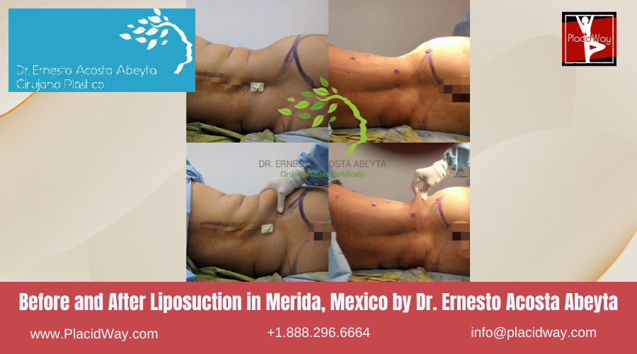 Liposuction in Merida, Mexico by Dr Ernesto Acosta Abeyta Before After Picture