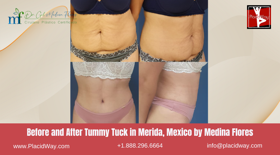 Tummy Tuck in Merida, Mexico by Medina Flores