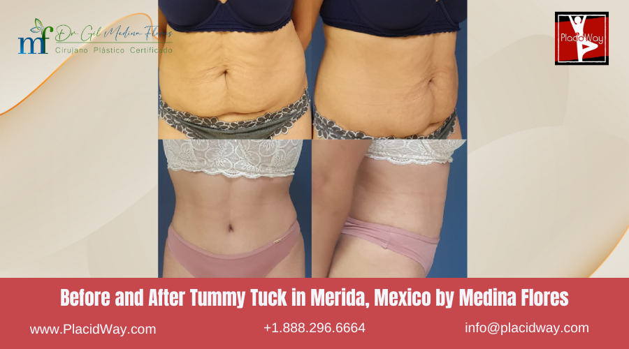 Tummy Tuck In Merida, Mexico By Medina Flores