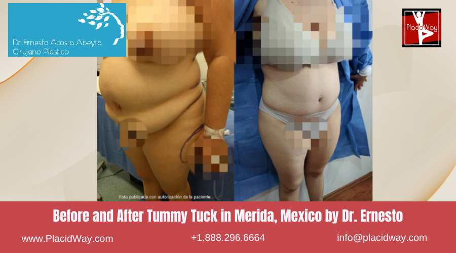 Tummy Tuck in Merida, Mexico by Dr Ernesto Acosta Abeyta