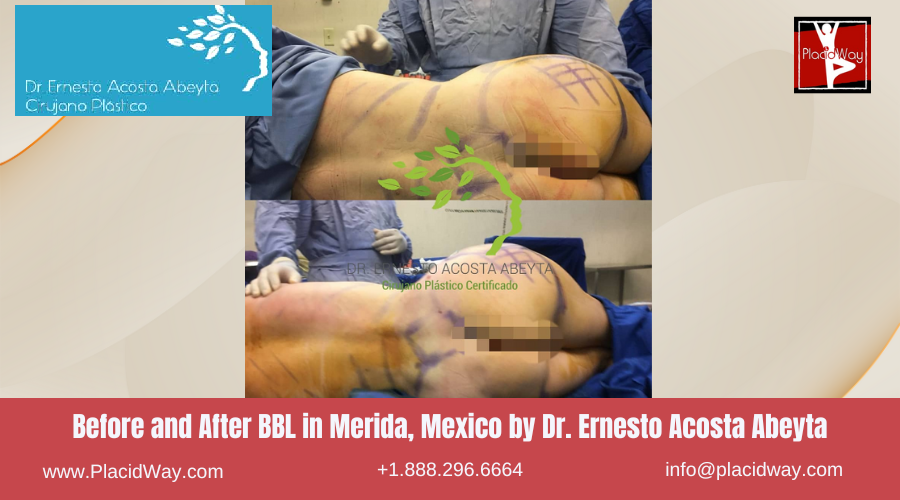 BBL in Merida, Mexico by Dr Ernesto Acosta Abeyta Before After Image
