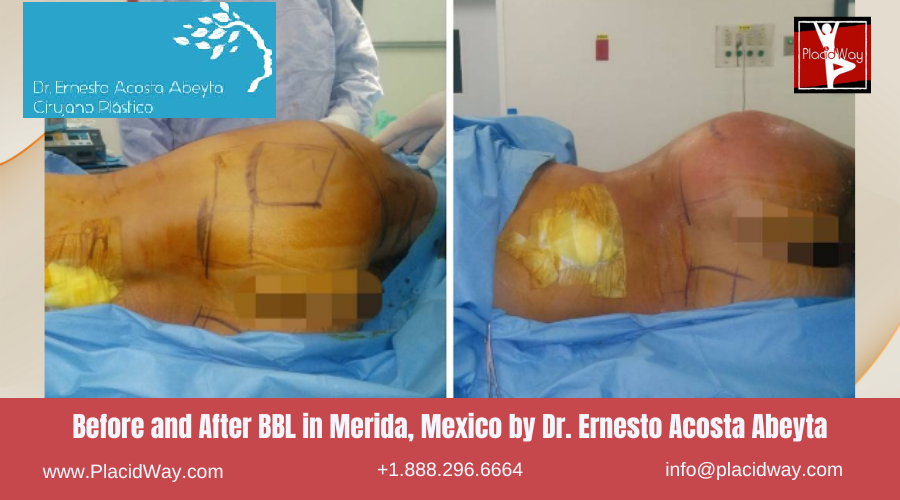 BBL in Merida, Mexico by Dr Ernesto Acosta Abeyta Before After Picture