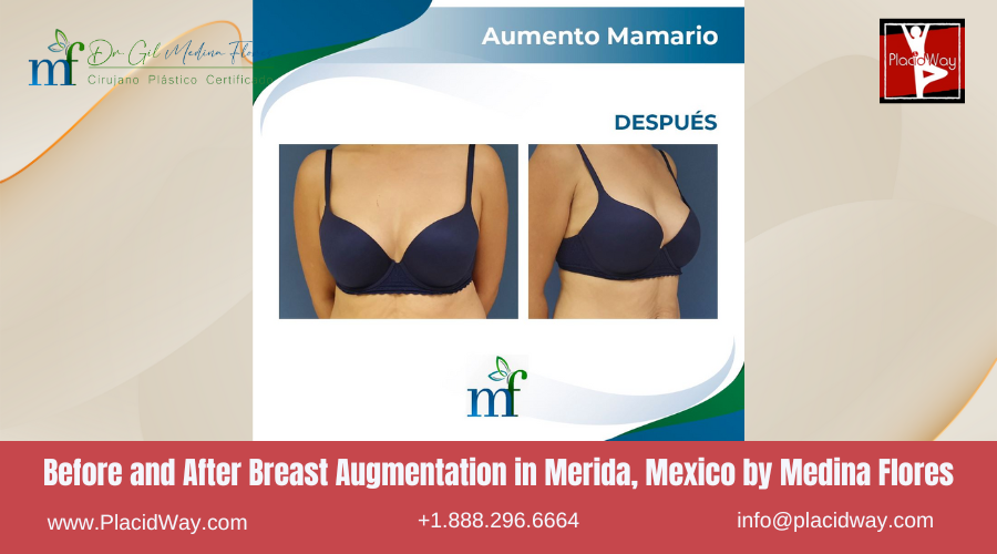 Breast Augmentation in Merida, Mexico by Medina Flores