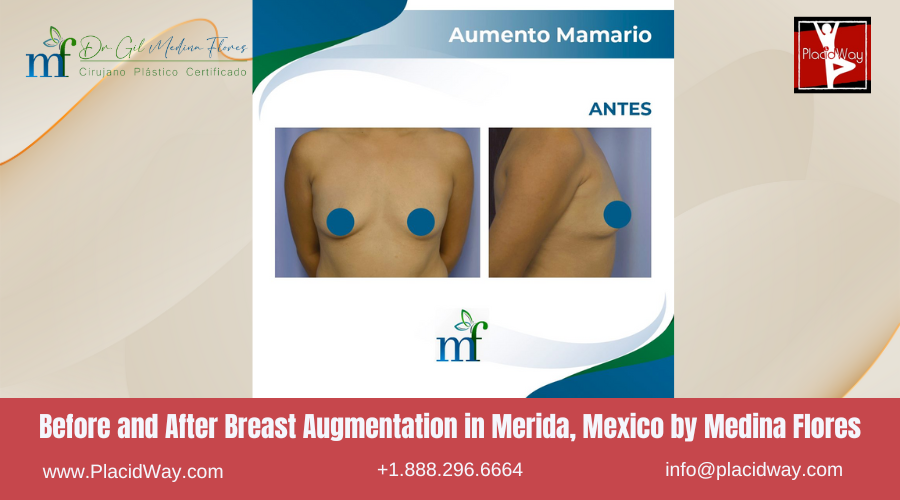 Breast Augmentation in Merida, Mexico by Medina Flores Before After Image