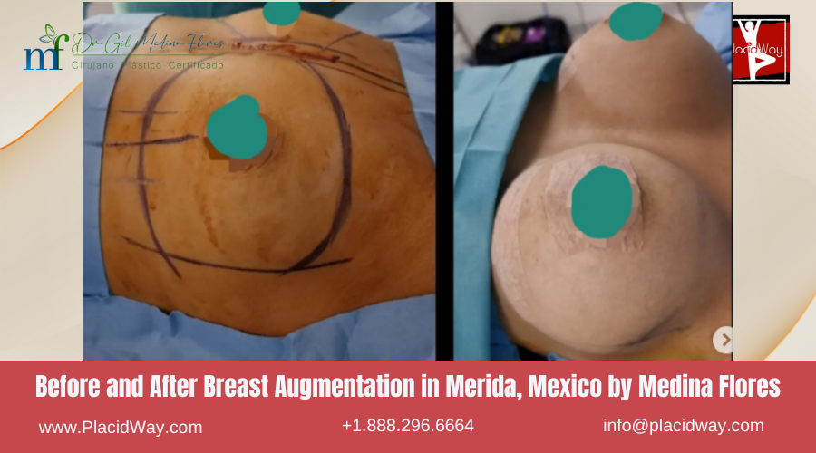 Breast Augmentation in Merida, Mexico by Medina Flores Before After Picture