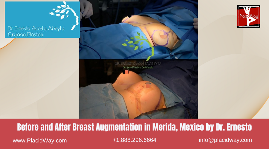 Breast Augmentation in Merida, Mexico by Dr Ernesto Acosta Abeyta