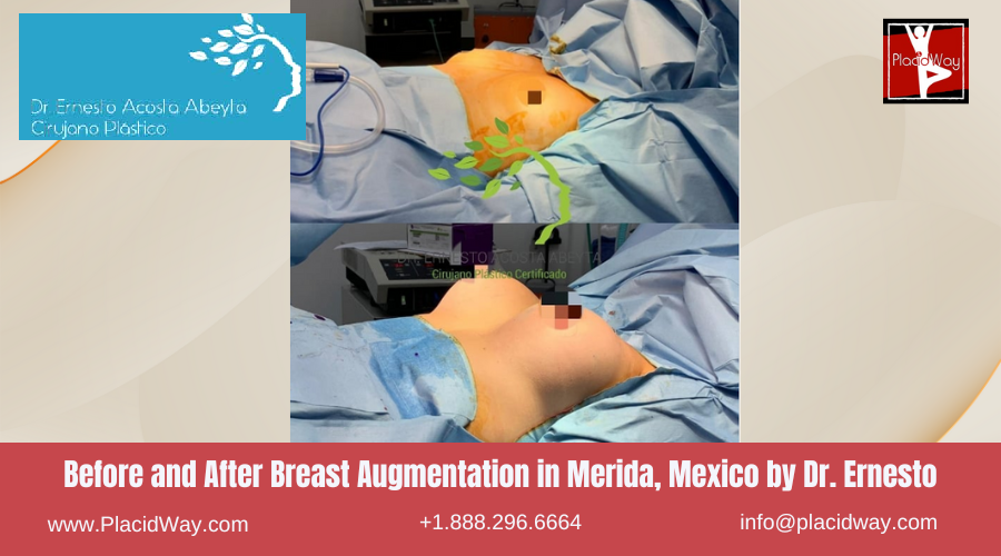 Breast Augmentation in Merida, Mexico by Dr Ernesto Acosta Abeyta Before After Image
