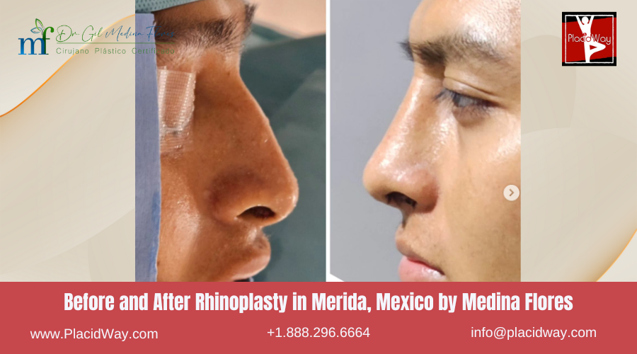 Rhinoplasty in Merida, Mexico by Medina Flores