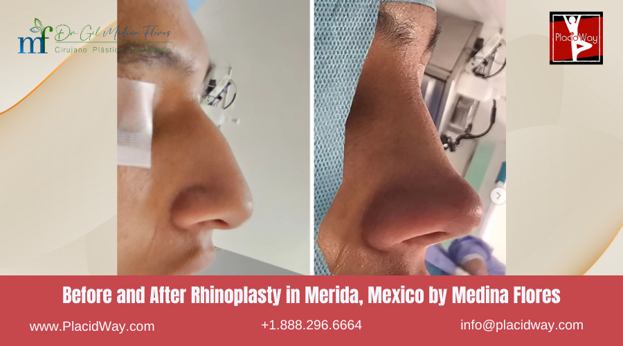 Rhinoplasty in Merida, Mexico by Medina Flores Before After Image