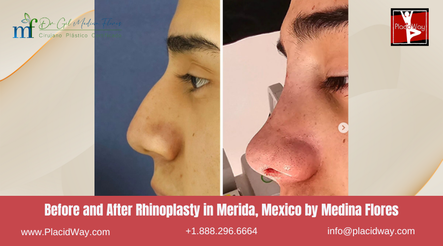 Rhinoplasty in Merida, Mexico by Medina Flores Before After Picture