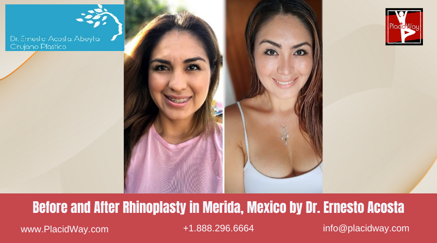 Rhinoplasty in Merida, Mexico by Dr Ernesto Acosta Abeyta