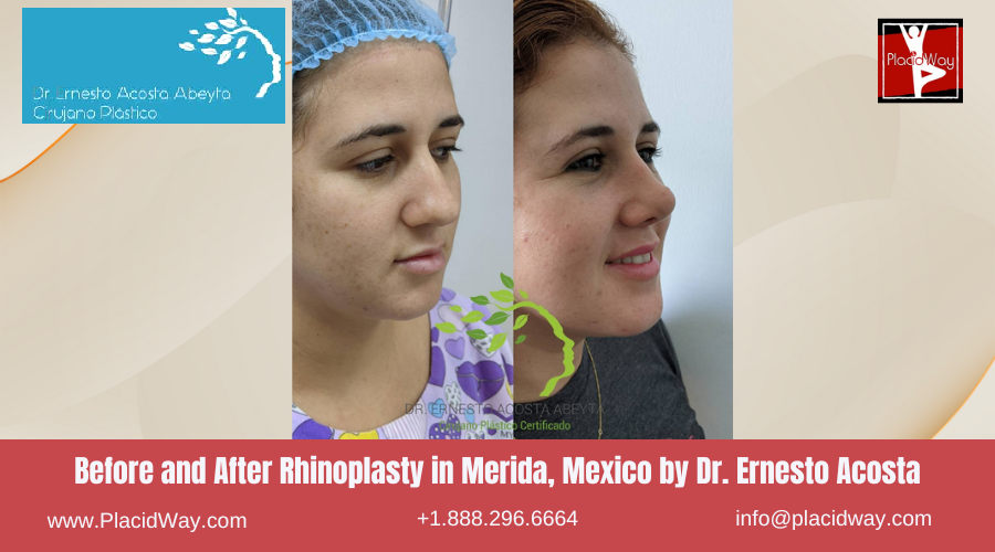 Rhinoplasty in Merida, Mexico by Dr Ernesto Acosta Abeyta Before After Image