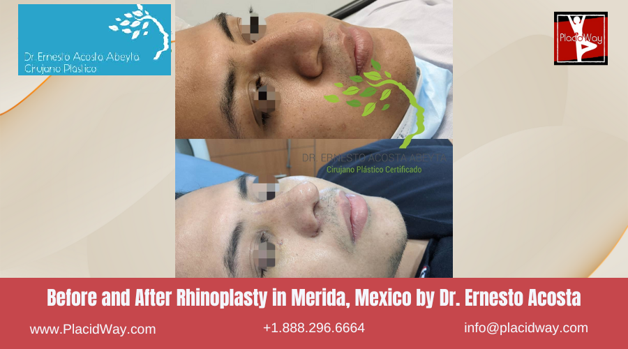 Rhinoplasty in Merida, Mexico by Dr Ernesto Acosta Abeyta Before After Picture